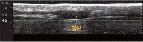 초음파 영상 — 혈관 위치 표시