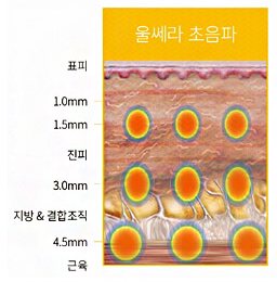 울쎄라 초음파 시술 깊이 도식(표피 1.0·1.5mm, 진피 3.0mm, 지방 & 결합조직 4.5mm, 근육)